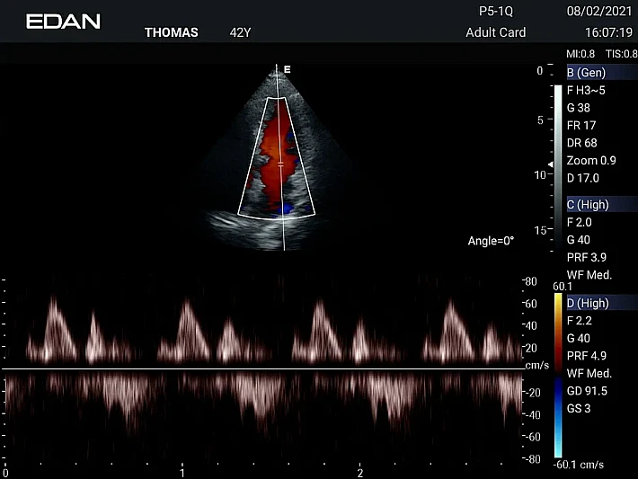 AX3 P5-1Q Cardiac (2)_result