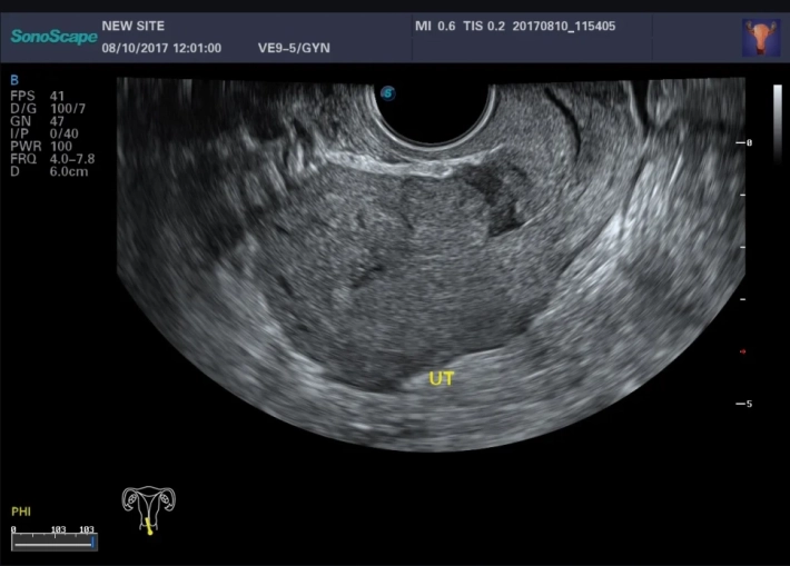 1. Рубец на матке_1_result