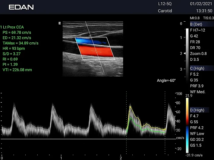 AX3 L12-5Q Upper limb blood vessel (4)_result