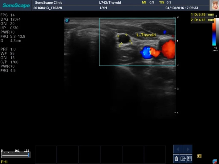 9. Киста щитовидной железы_ЦДК_result