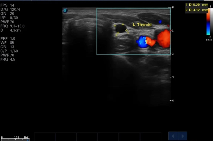 9. Киста щитовидной железы_ЦДК_result