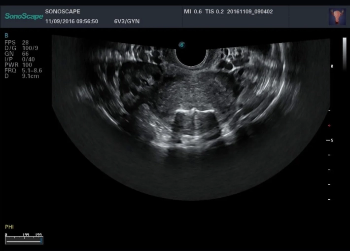 4. Внутриматочная спираль_1_result