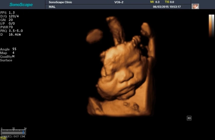 2. Лицо плода_3D_1_result