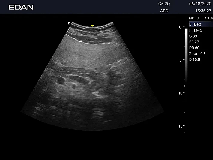 LX3 C5-2Q Pancreas_20200618 (6)_result