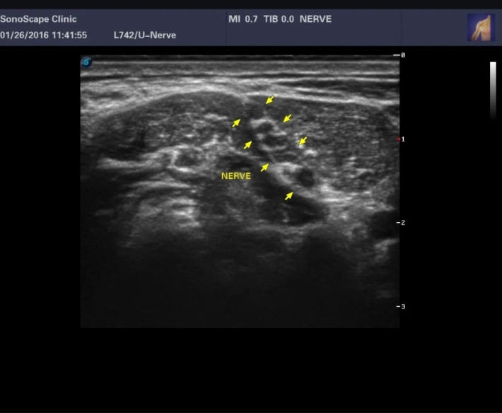 1. Плечевое сплетение межлестничный промежуток_result