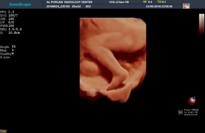 3. Ножка плода_ S_Live_result