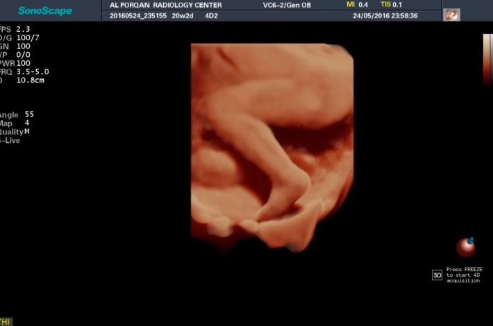 3. Ножка плода_ S_Live_result