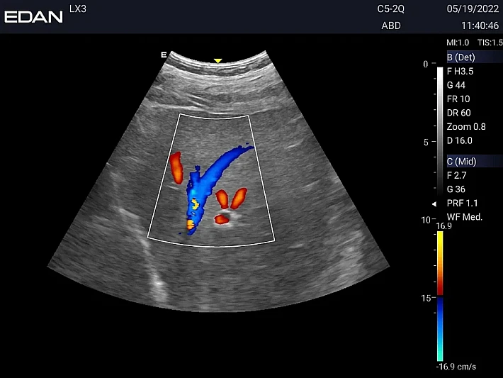 LX3 C5-2Q liver 20220519113818_0005 (6)_result