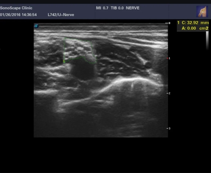 2. Плечевое сплетение надключичная область_result