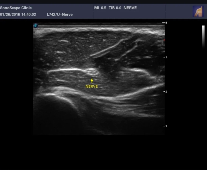 3. Мышечно-кожный нерв_result