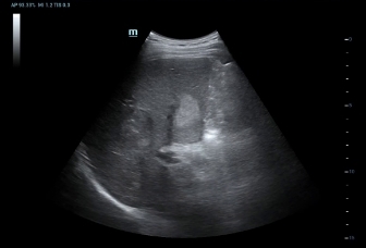 01-d8-2u-liver-hcc-b
