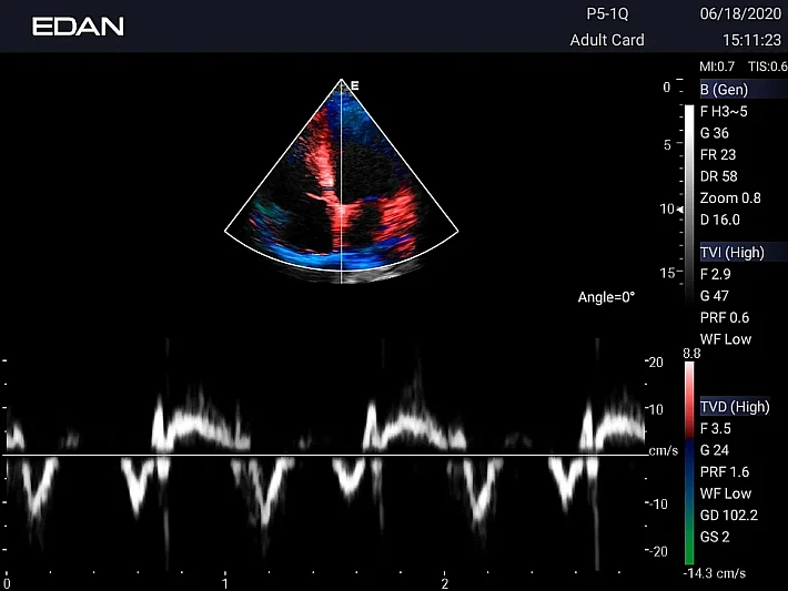 LX3 P5-1Q Cardiac TDI_result