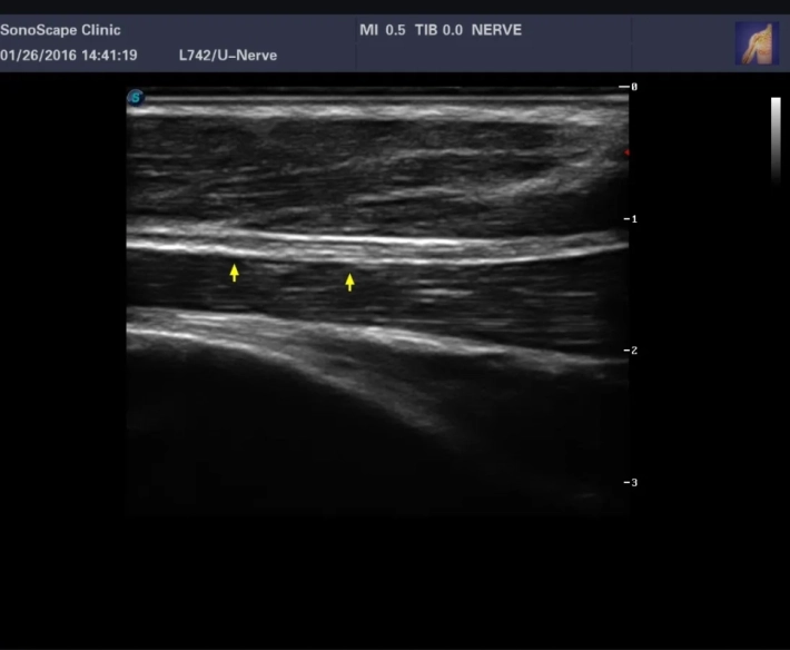5. Срединный нерв_result
