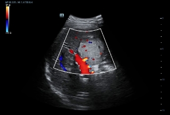 02-d8-2u-liver-hcc-color