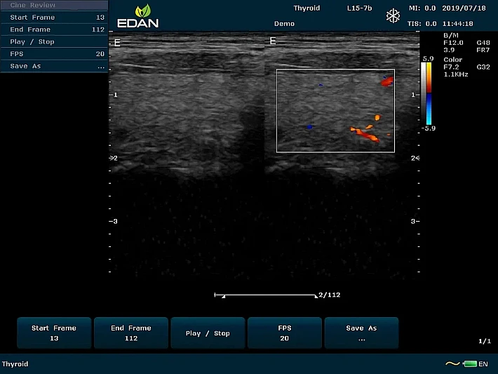 U60 L15-7b Thyroid_result