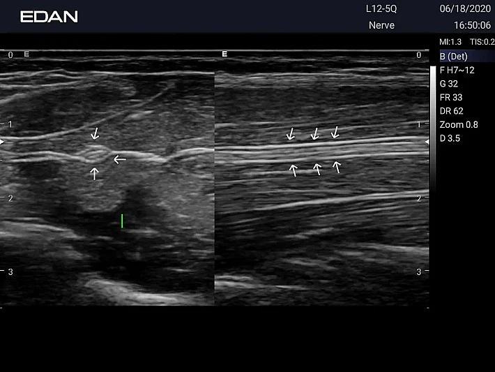LX3 L12-5Q Nerve_20200618_0062_result