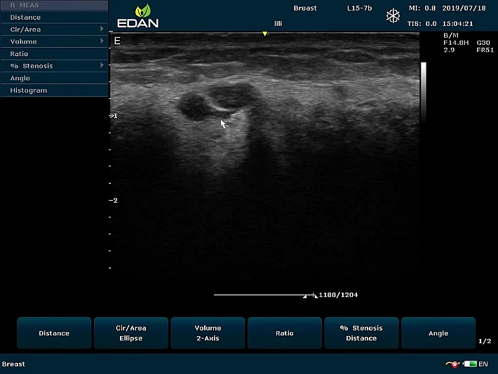 U60 L15-7b Breast_result