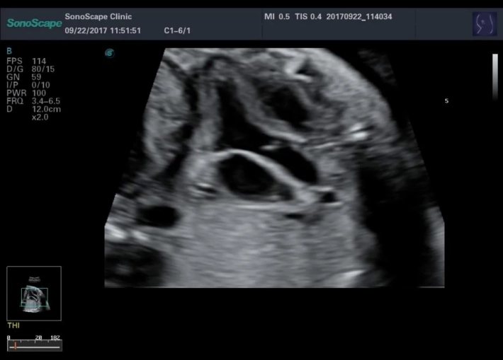 1.2 Выносящий тракт левого желудочка_result