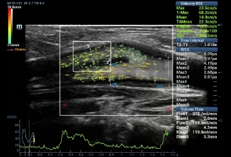 05-l11-3u-carotid-vflow