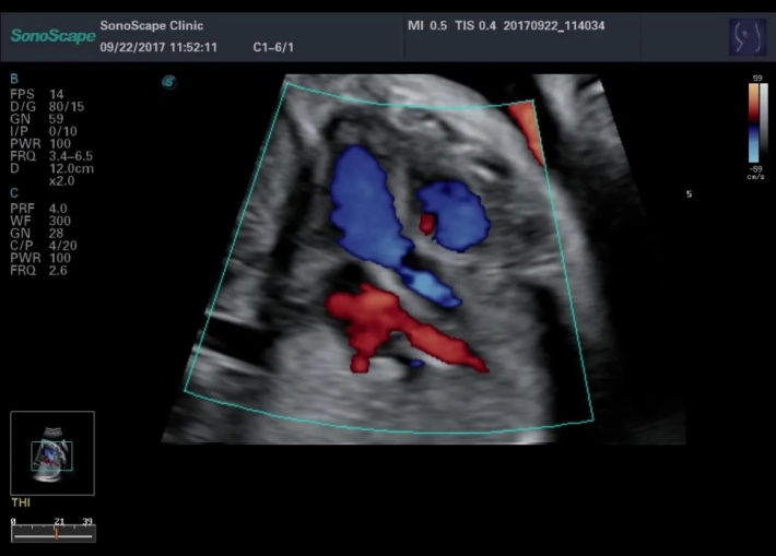 2. Выносящий тракт левого желудочка_ЦДК_result