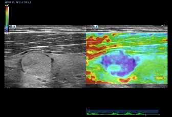 06-l11-3u-thyroid-mass-elasto