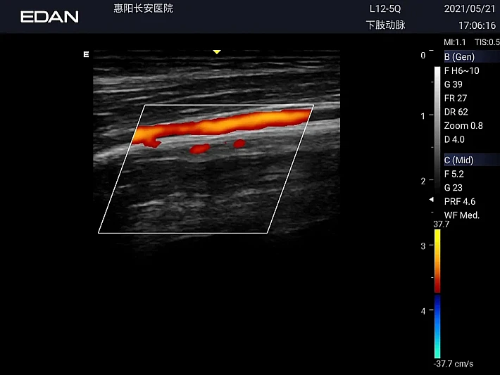 LX3 L12-5Q Low Artery_20210521 (2)_result