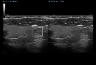 07-l11-3u-thyroid-nodule-hd