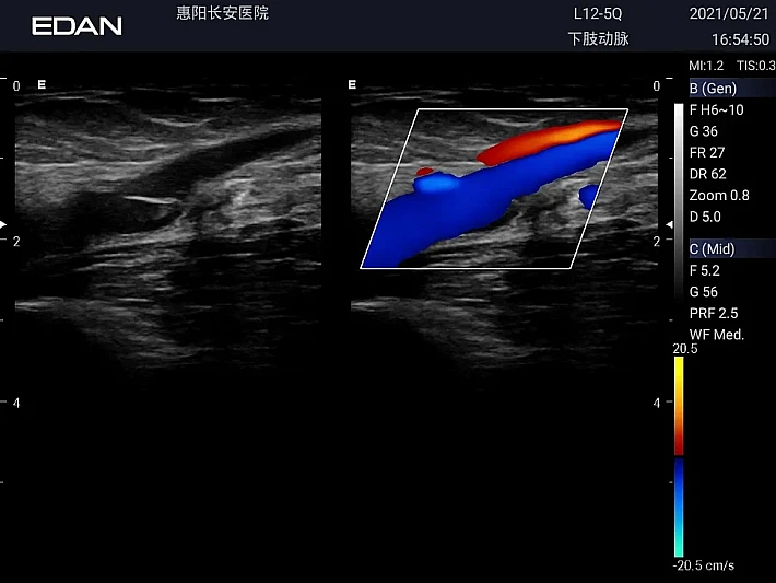 LX3 L12-5Q Low Artery_20210521 (1)_result