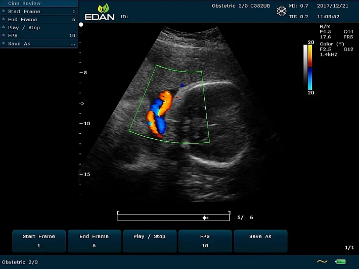 U60 C352UB Fetus2_result