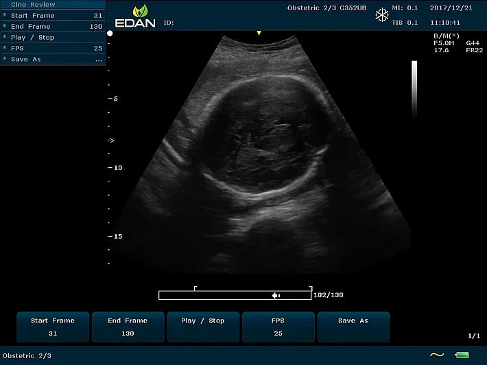 U60 C352UB Fetus1_result