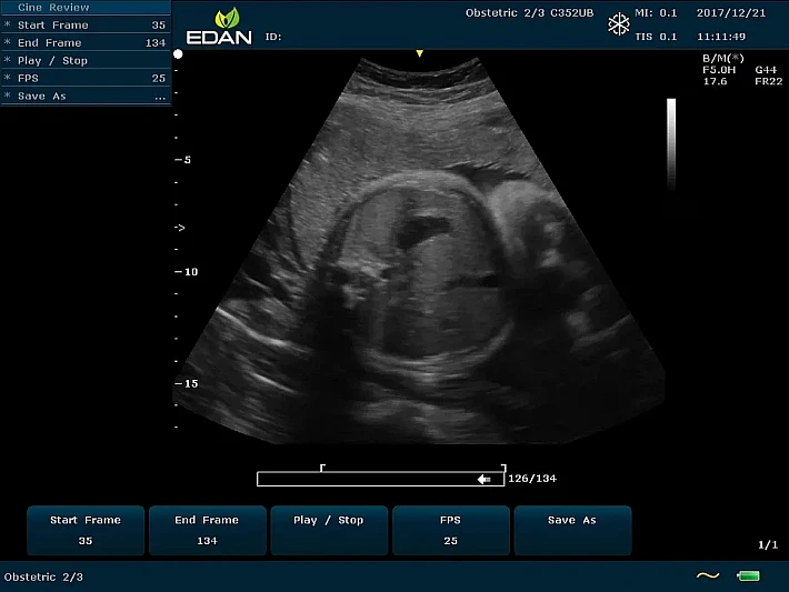 U60 C352UB Fetus_result