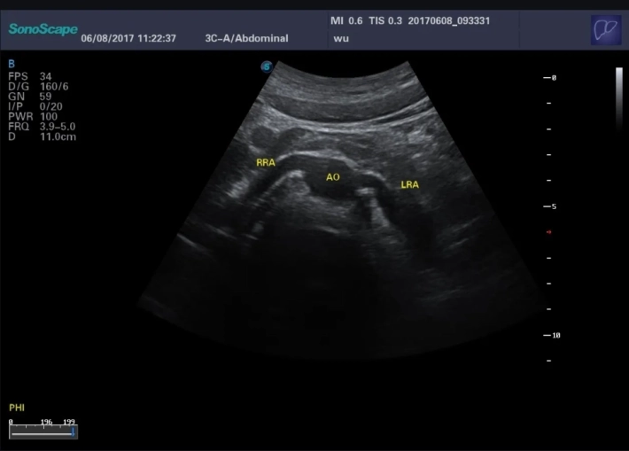 3. Почечные артерии_result