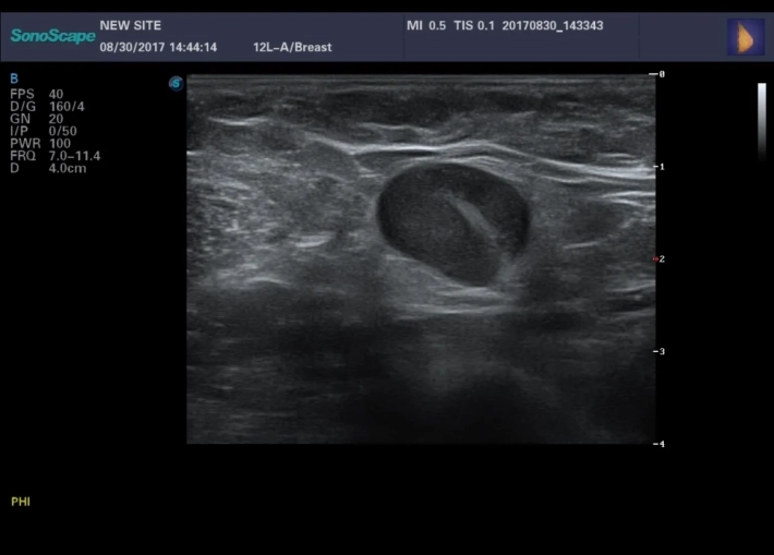 3. Рак молочной железы_result