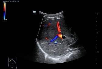 12-sc5-1u-liver-hepatic-cancer-color