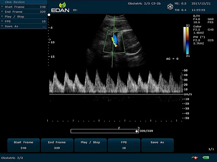 U60 C5-2b Fetus Umbilical cord blood flow (8)_result