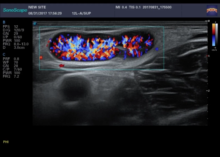 10. Лимфоузел_ЦДК_result