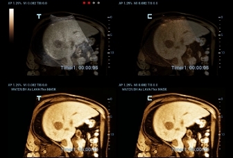13-sc5-1u-liver-ifusion