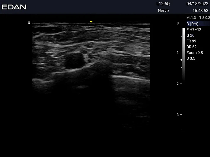 LX3 L12-5Q brachial plexus (2)_result