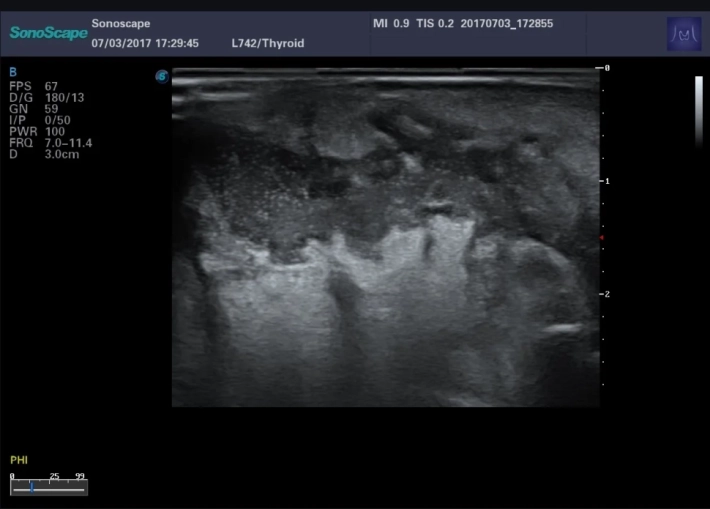 13. Абсцесс тыльной стороны стопы_result