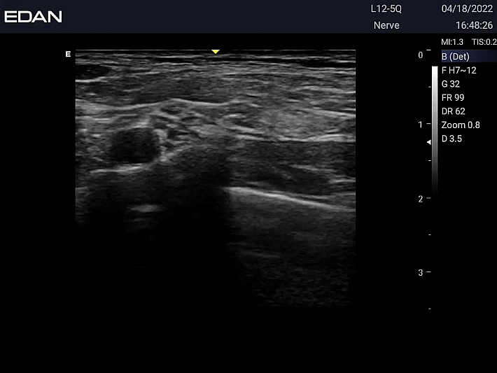 LX3 L12-5Q brachial plexus (1)_result