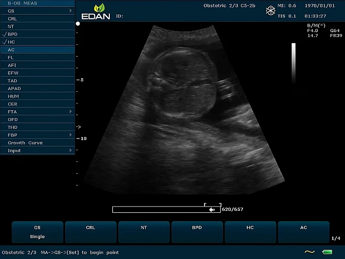 U60 C5-2b Fetus (3)_result