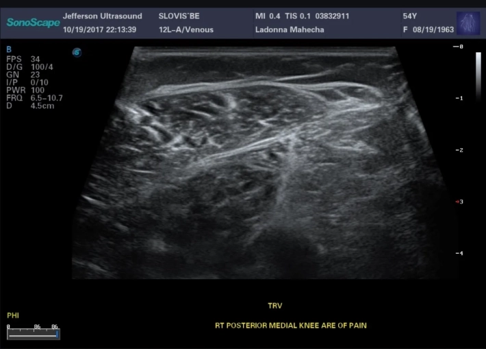 16. Трапецеидальное сканирование на линейном датчике_result