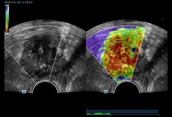 15-v11-3hu-prostate-cancer-elasto