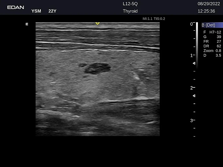 LX9 L12-5Q Thyroid_20220829 (1)_result