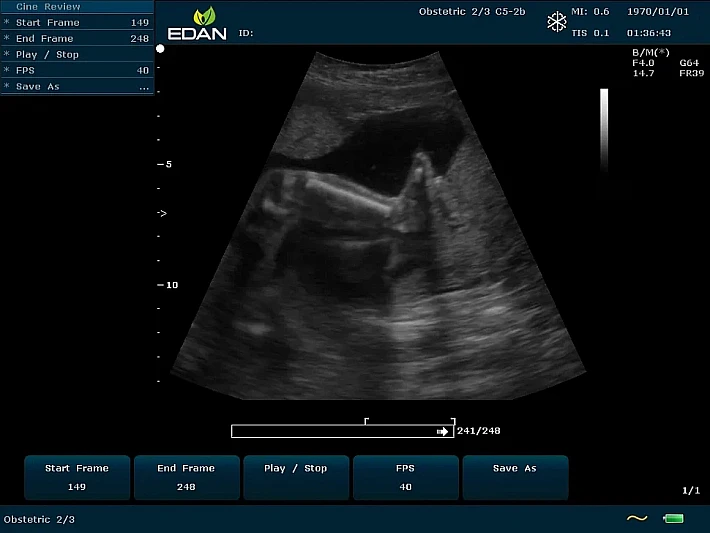 U60 C5-2b Fetus (1)_result