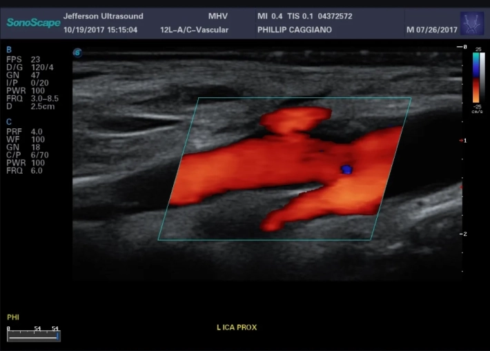 Бифуркация общей сонной артерии_ЦДК_result