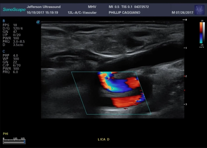 Внутренняя сонная артерия дистальная часть_result