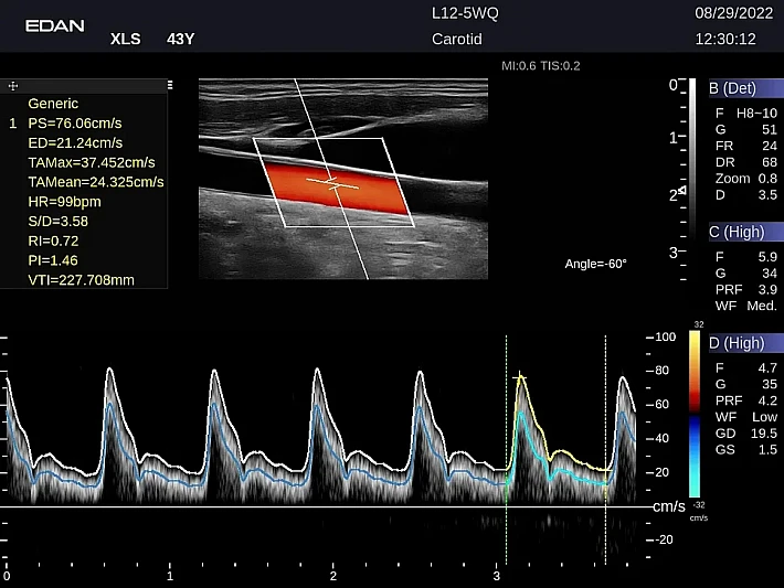 LX9 L12-5WQ Carotid_20220829 (1)_result
