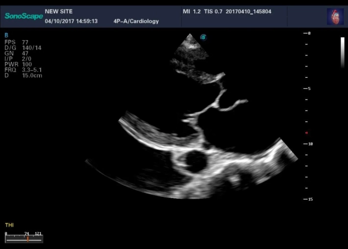 1. 6. ЛЖ длинная ось_result
