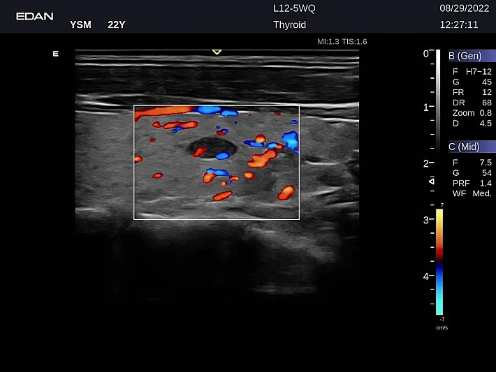 LX9 L12-5WQ Thyroid_20220829 (3)_result